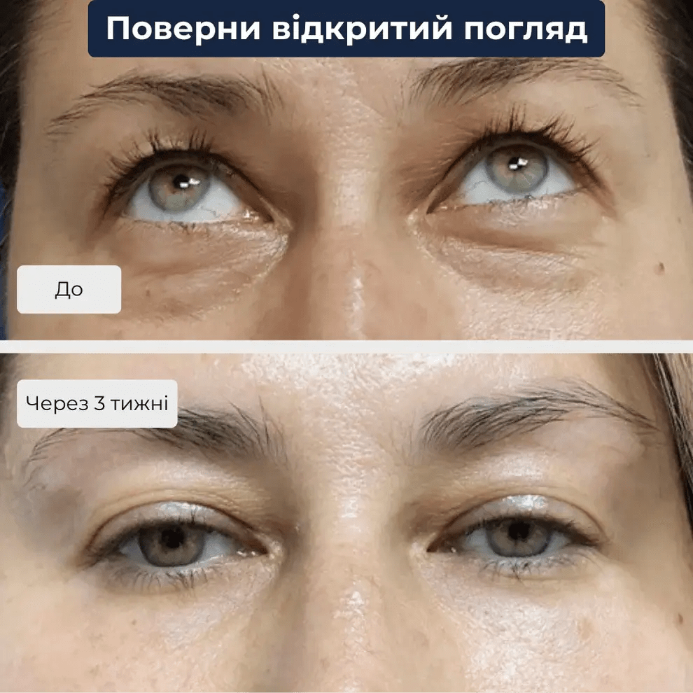 Ліпофілинг обличчя