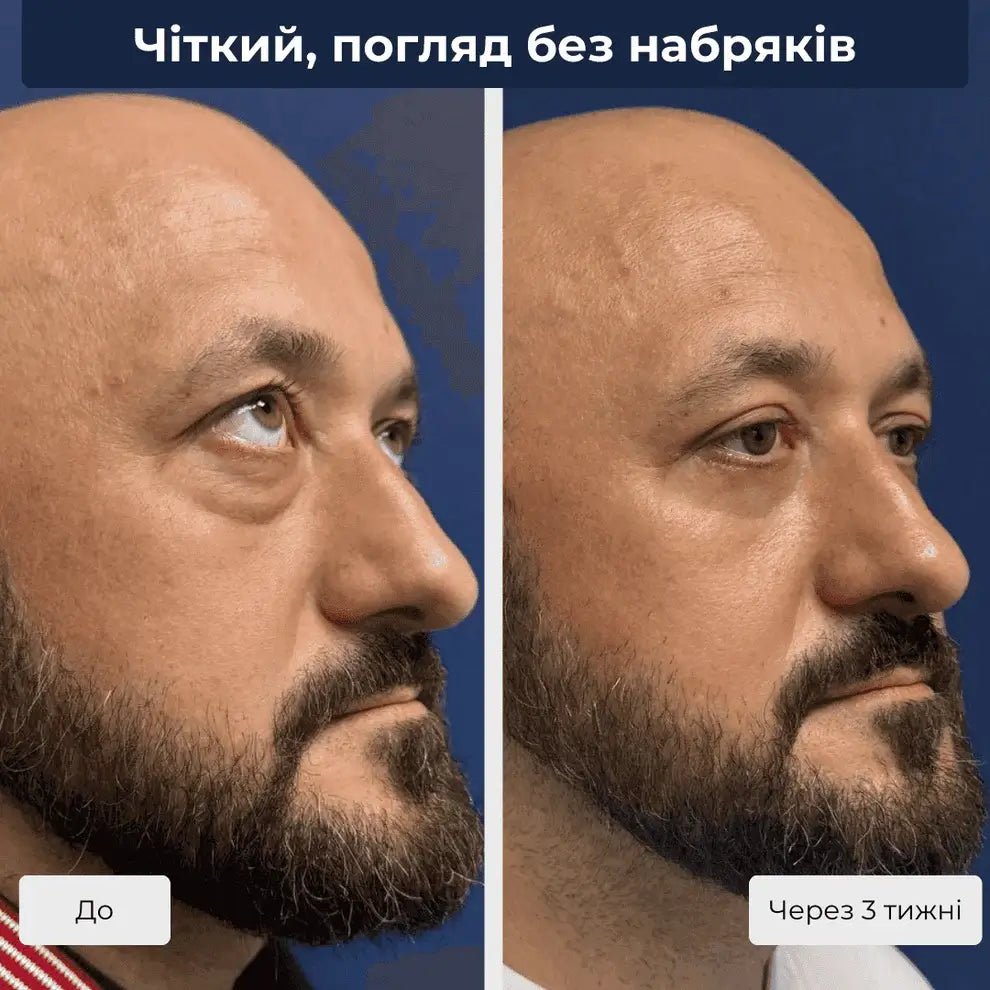 блефаропластика для чоловіків до після