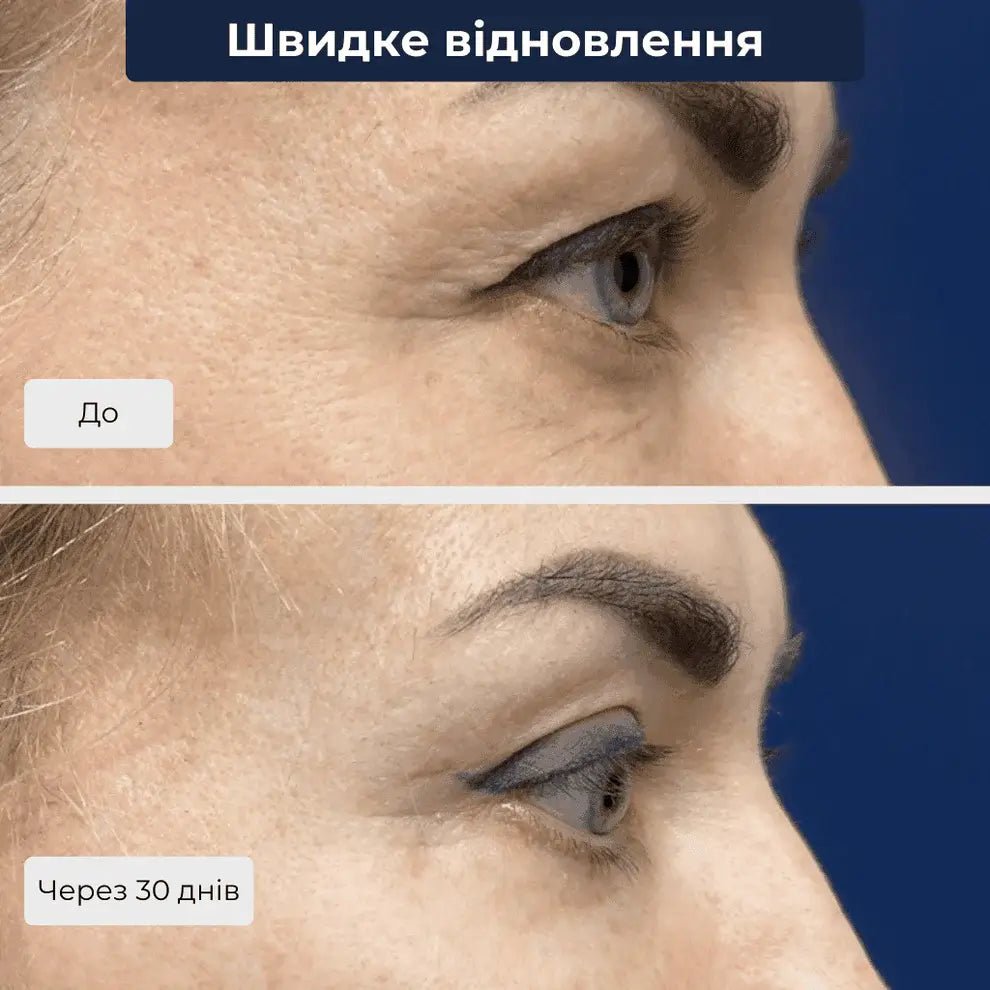 операція на повіках