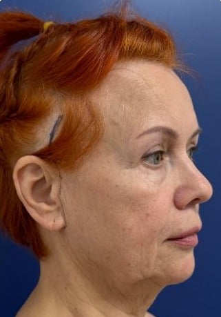 Підтяжка обличчя та шиї з ліпосакцією та нижньою блефаропластикою