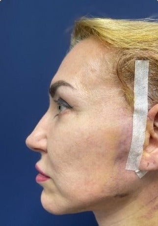 Підтяжка нижньої третини обличчя та шиї
