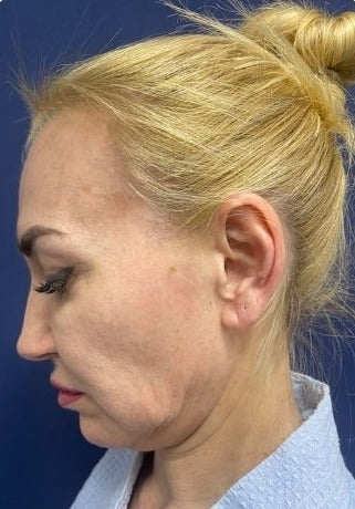 Підтяжка нижньої третини обличчя та шиї