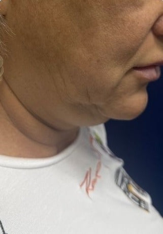 Підтяжка нижньої третини обличчя та шиї
