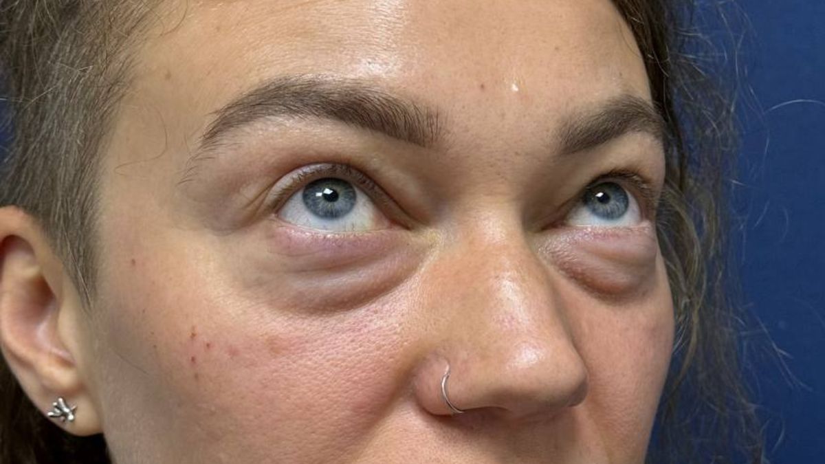 Нижня блефаропластика