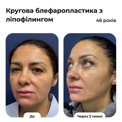 Блефаропластика