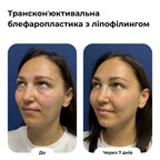 Блефаропластика