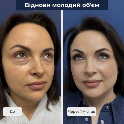 Ліпофілинг обличчя