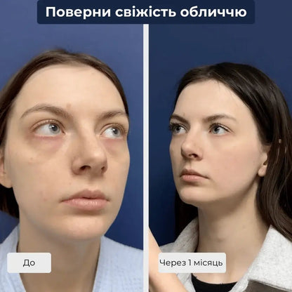 Ліпофілинг обличчя київ