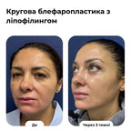 Блефаропластика