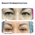 Блефаропластика