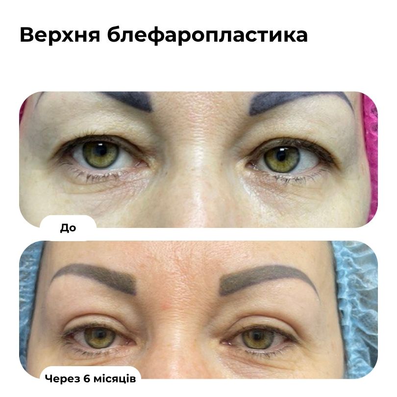 Блефаропластика