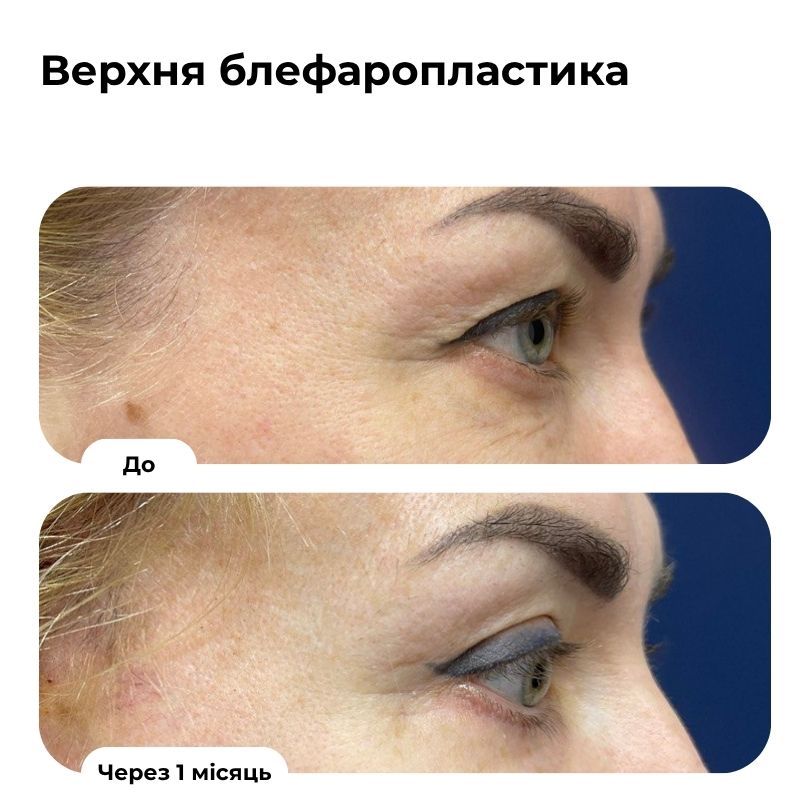 Блефаропластика