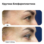 Блефаропластика