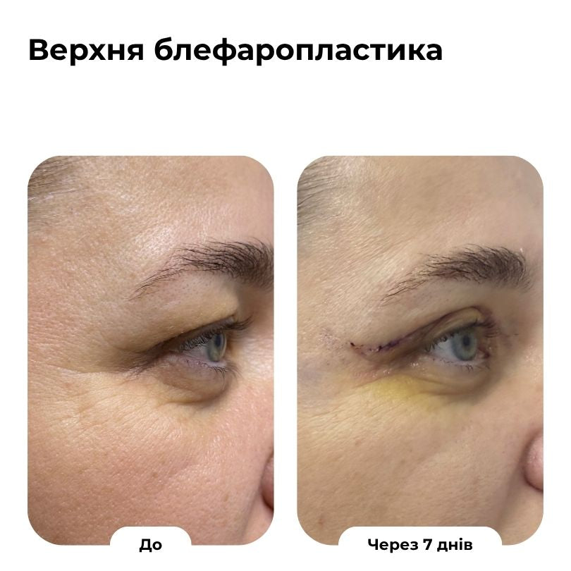 Блефаропластика