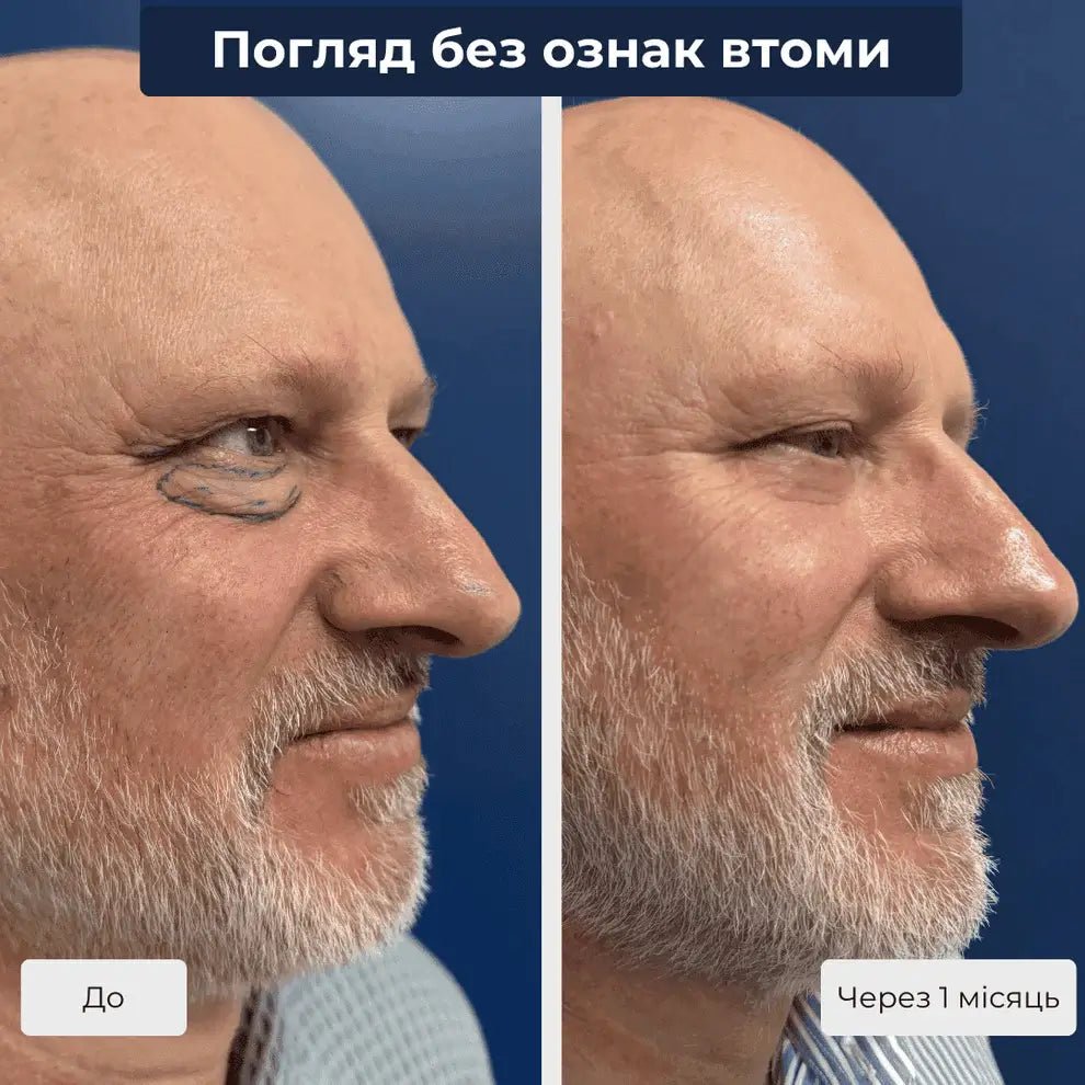 чоловіча блефаропластика фото до після