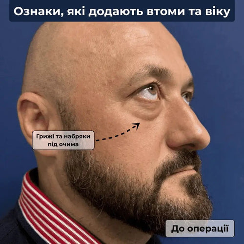 видалення гриж під очима у чоловіків