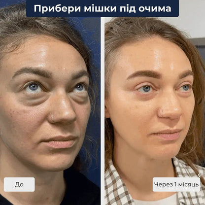 Блефаропластика фото до після