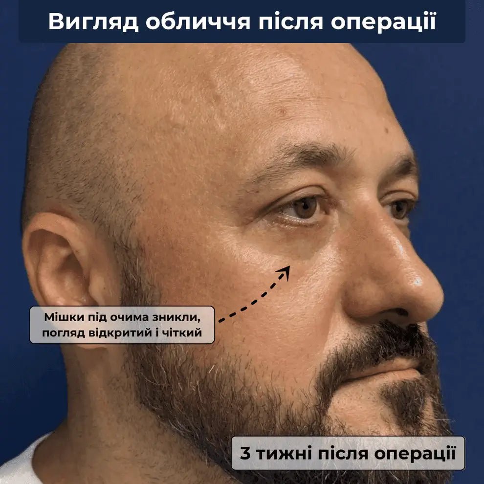 вигляд після проведення чоловічої блефаропластики