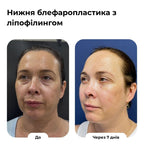 Блефаропластика
