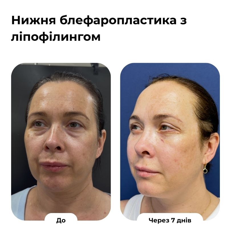 Блефаропластика