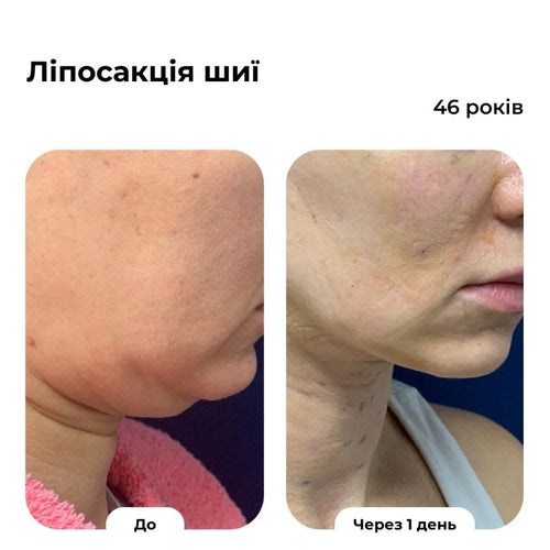 Ліпосакція