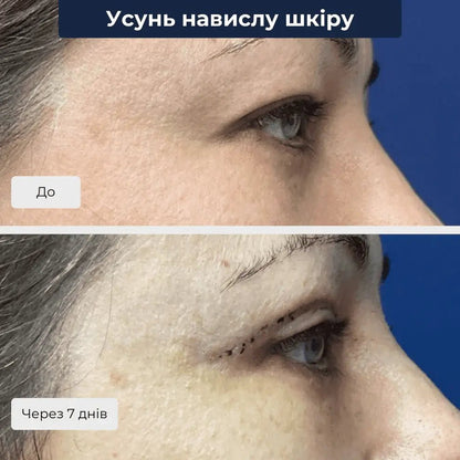 пластика повік київ