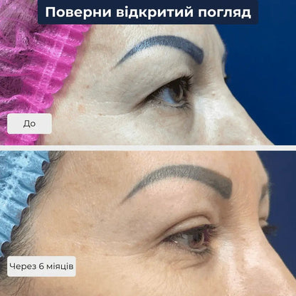 підтяжка повік