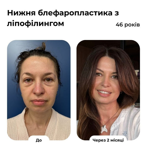 Блефаропластика