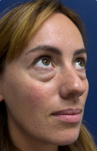 До операції: Нижня блефаропластика з ліпофілінгом