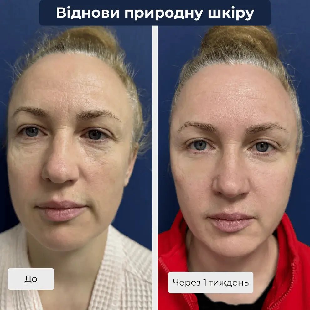 Ліпофілинг обличчя