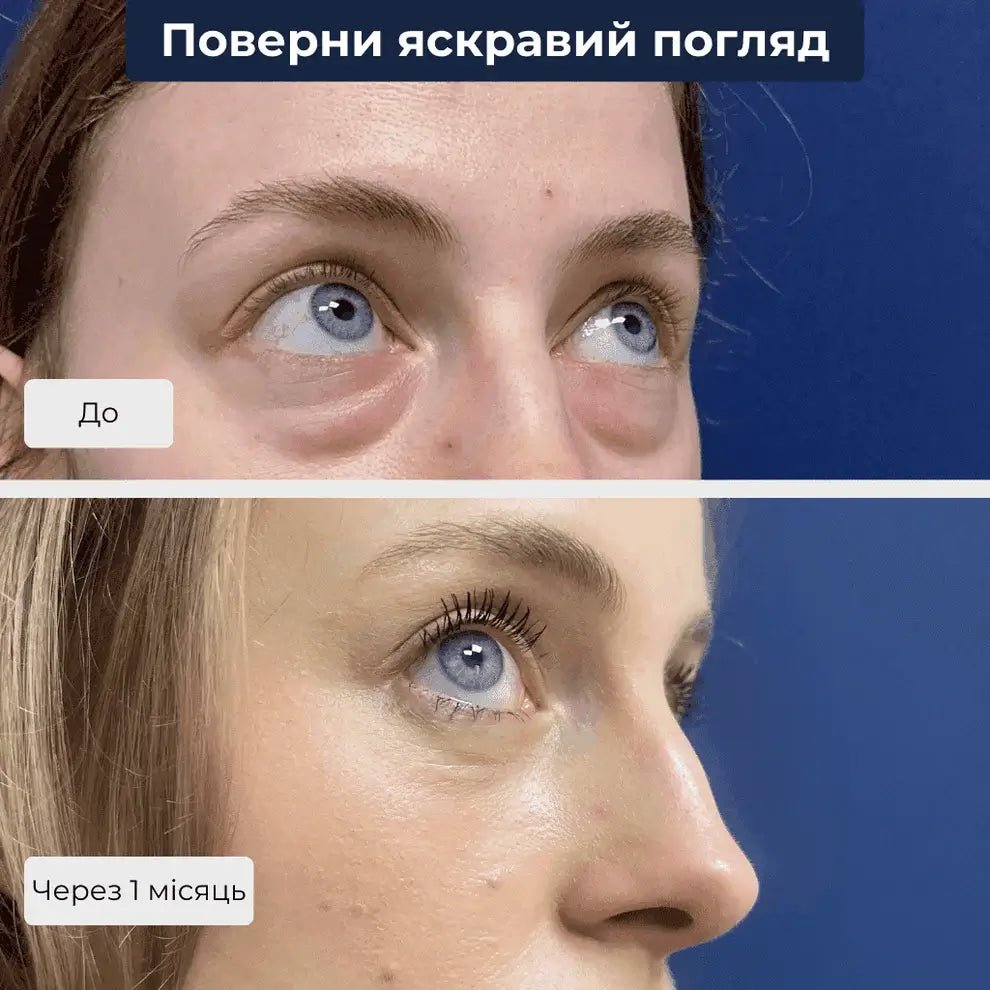 блефаропластика київ
